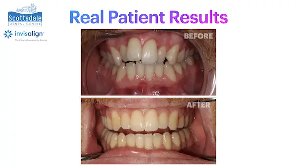 Real Invisalign Results in Guelph
