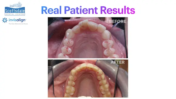 Real Invisalign Results in Guelph
