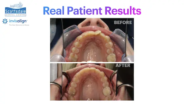 Real Invisalign Results in Guelph