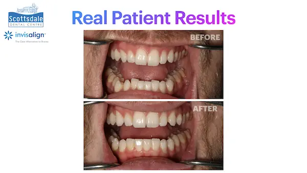 Real Invisalign Results in Guelph