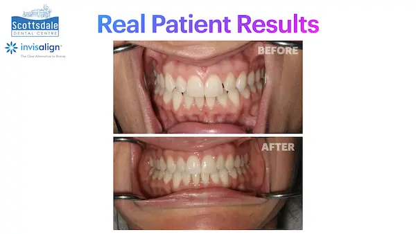 Real Invisalign Results in Guelph