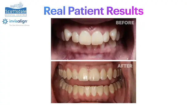 Real Invisalign Results in Guelph