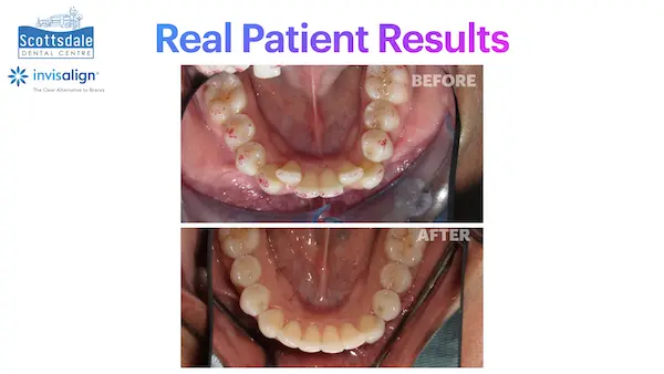 Real Invisalign Results in Guelph