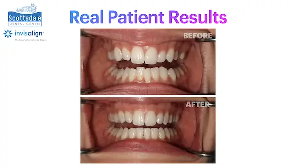 Real Invisalign Results in Guelph