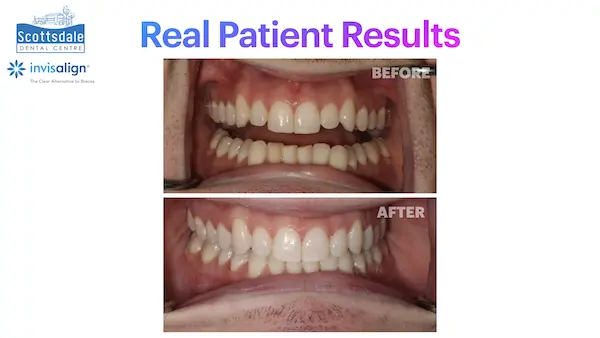 Real Invisalign Results in Guelph